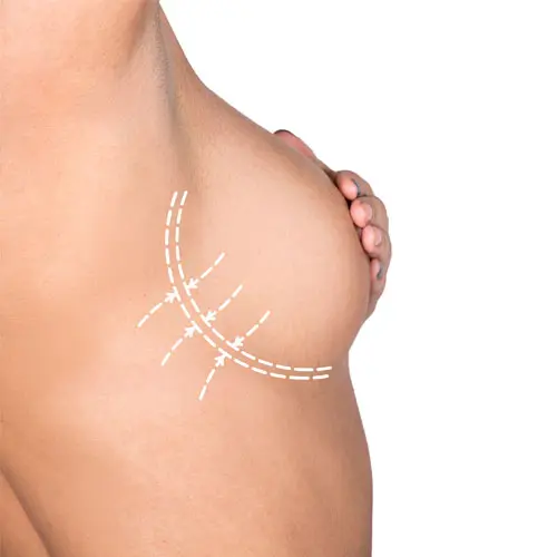 breast-lift-egypt-price