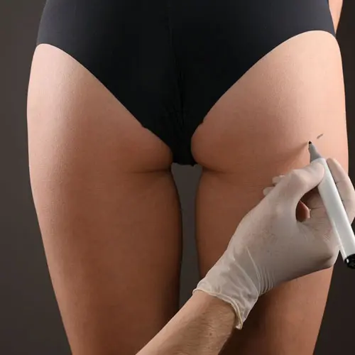 buttock-lipofilling-egypt